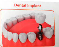 dental implants